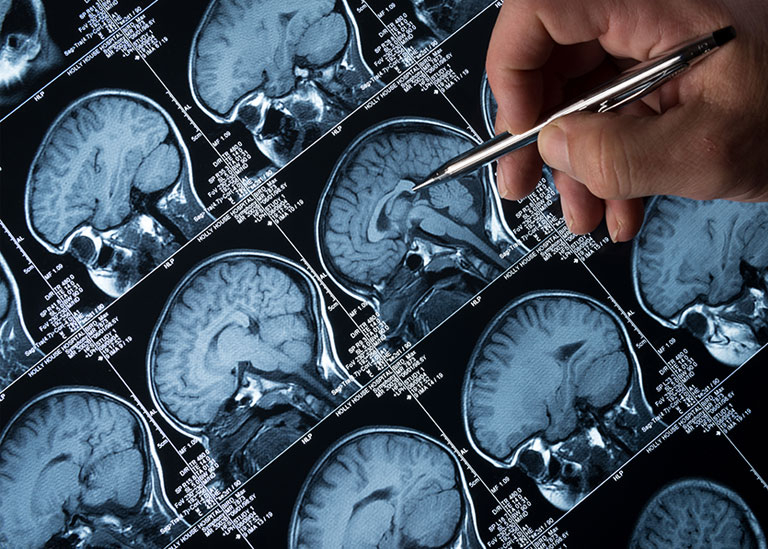 Doctor using pen to point out area on brain scan